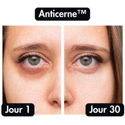 Anticerne™ Thérapie par la Lumière Rouge