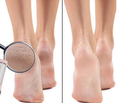 ÉclatPieds™ Outil de Soin Podologique